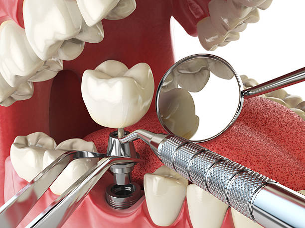 Best Emergency Dentist for Lost Fillings or Crowns in Hopewell, NJ